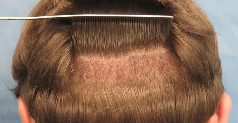 افضل 5 عيادات في زراعة الشعر في رابع الرياض بسعر لا يقاوم في مدينة الرياض