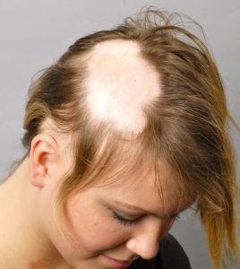علاج الثعلبه في ثلاث ايام