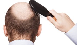 علاج تساقط الشعر عند الرجال