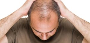 علاج تساقط الشعر عند الرجال