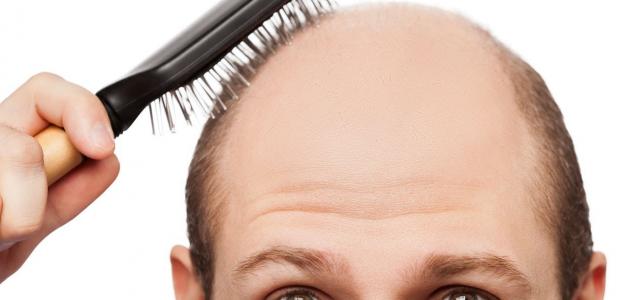 علاج تساقط الشعر عند الرجال الوراثي