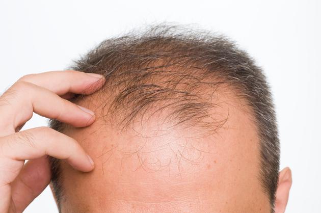 علاج تساقط الشعر عند الرجال بالاعشاب 