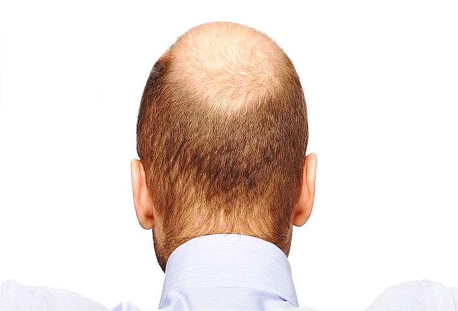 علاج تساقط الشعر عند الرجال بعد الفرد