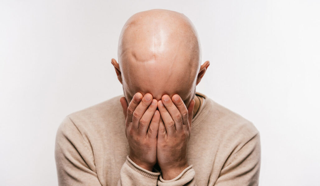 علاج تساقط الشعر عند الرجال من الامام 