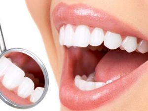 اسعار عدسات الاسنان في تركيا