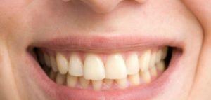 اضرار تركيب ابتسامة هوليود