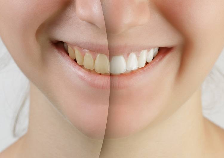 انواع تجميل الاسنان