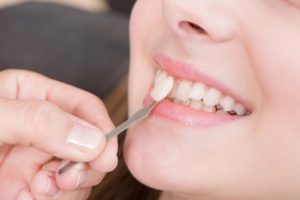 تجميل الاسنان في تركيا