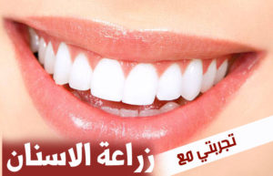زراعة الاسنان في تركيا وتكلفتها