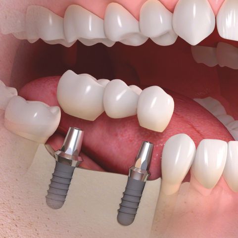 طريقة زراعة الاسنان بالتفصيل