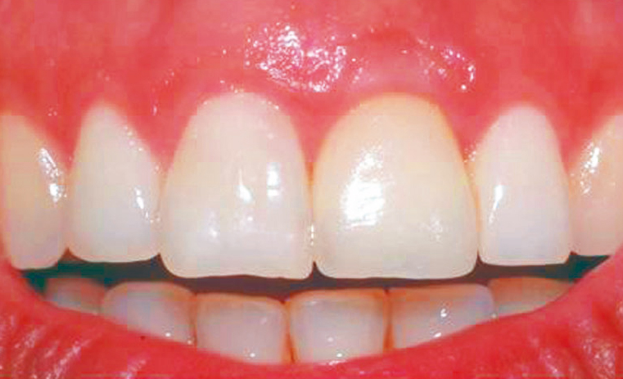 مدة زراعة الاسنان بعد الخلع