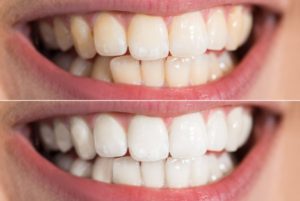 نصائح ابتسامة هوليود