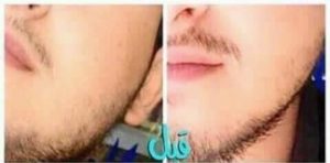  زيت الحشيش لانبات شعر الذقن