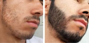 علاج تكثيف الذقن