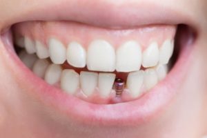 افضل مراكز زراعة الاسنان في تركيا